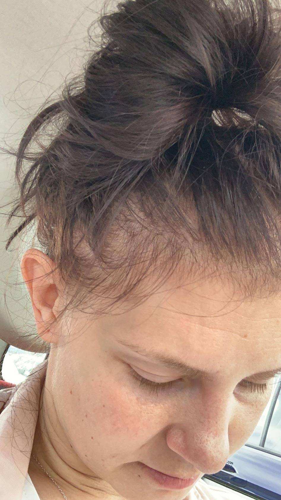 The TRUTH about postpartum hair loss (what they don't tell you!) Emma